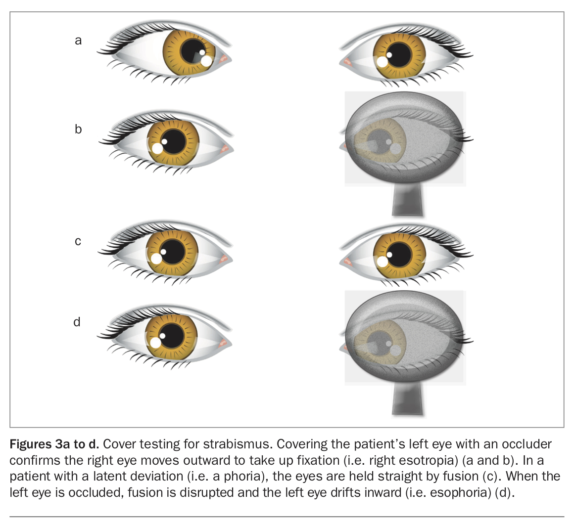 strabismus-what-gps-need-to-know-medicine-today